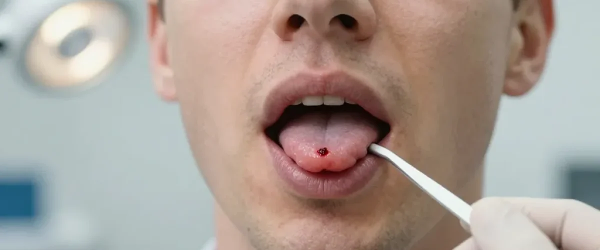 petite boule de sang dans la bouche